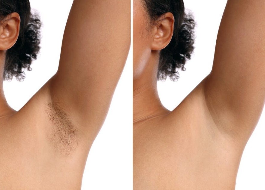 Laser Haarentfernung in Jena