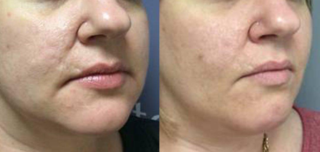 Secret RF Microneedling in Jena – Ausgangssituation vor der Behandlung