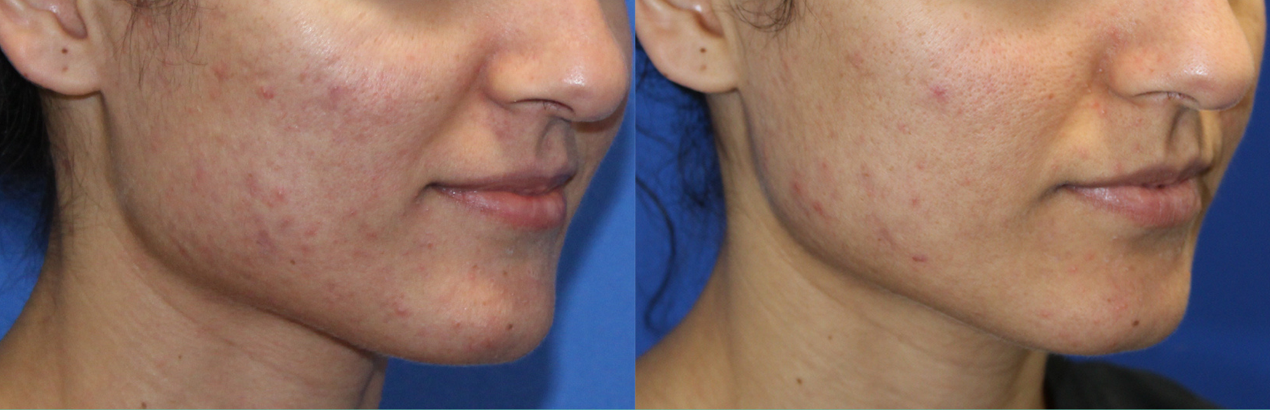 Secret RF Microneedling in Jena – Ausgangssituation vor der Behandlung