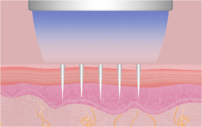 Schritt 2 – Nadeln dringen in die Haut ein