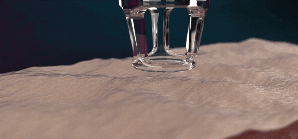 1540nm Lasermodus – fraktionierter Er:Glass Laser mit Secret DUO in Jena