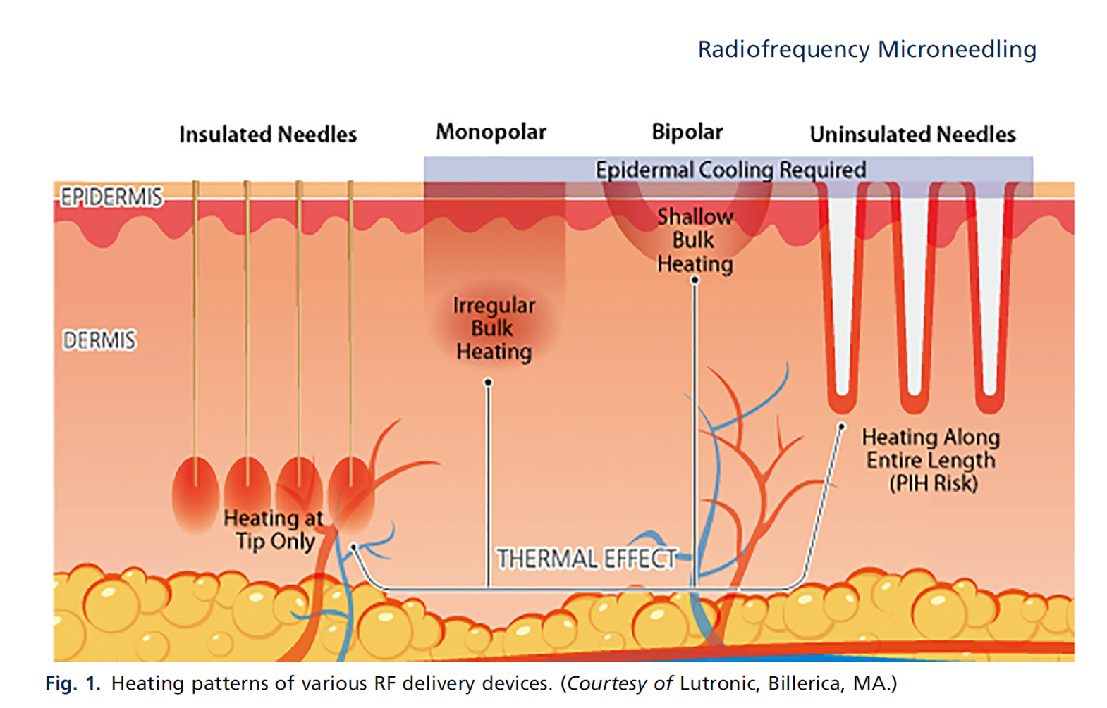 RF Microneedling vs. klassisches Microneedling – Unterschiede, Wirkung und medizinische Bewertung