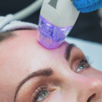 Microneedling Sitzungen