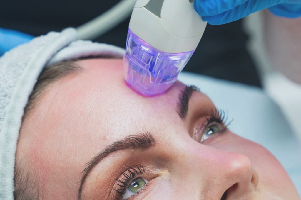 Microneedling Sitzungen