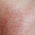 Teleangiektasien, Couperose und Rosacea – Wo liegt der Unterschied?