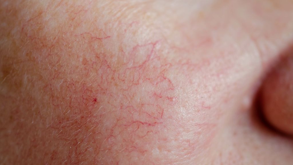 Teleangiektasien, Couperose und Rosacea – Wo liegt der Unterschied?