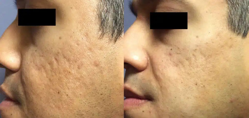 Microneedling bei Akne
