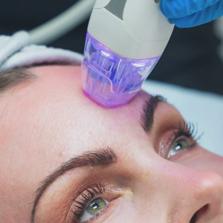 Microneedling Sitzungen