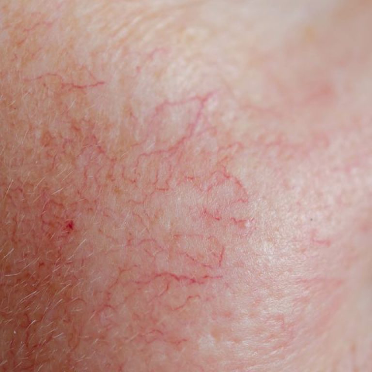 Teleangiektasien, Couperose und Rosacea – Wo liegt der Unterschied?