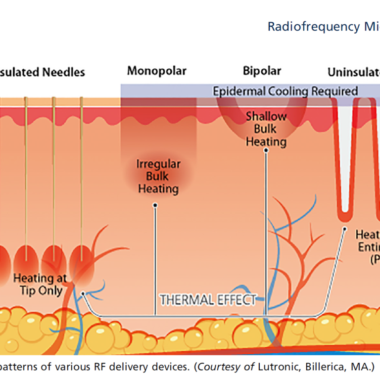 RF Microneedling vs. klassisches Microneedling – Unterschiede, Wirkung und medizinische Bewertung