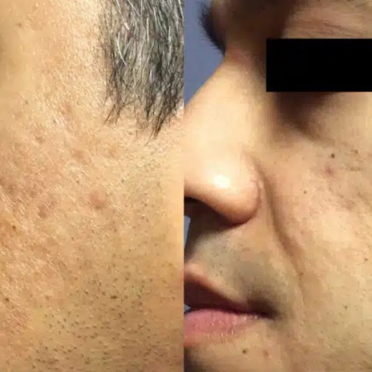 Microneedling bei Akne